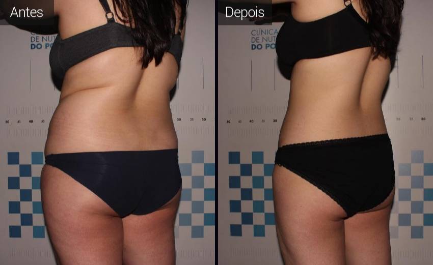 resultados - abdomen - flancos - coxa - vista lateral